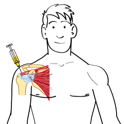 How Steroids Affect the Body