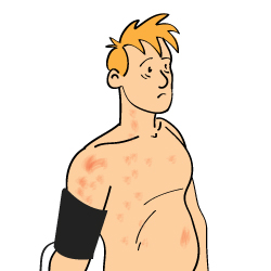 Side Affects of Cortisone